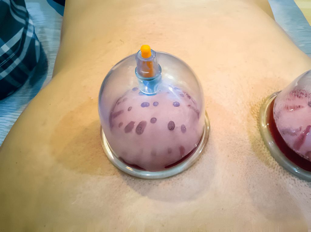 Hijama in Dubai