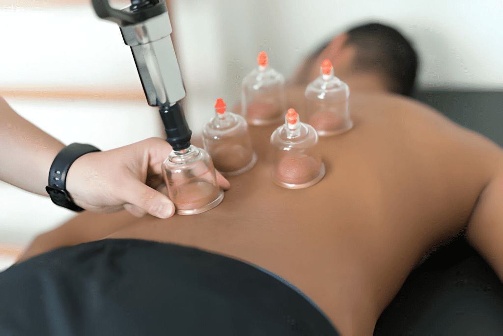 Hijama Therapy