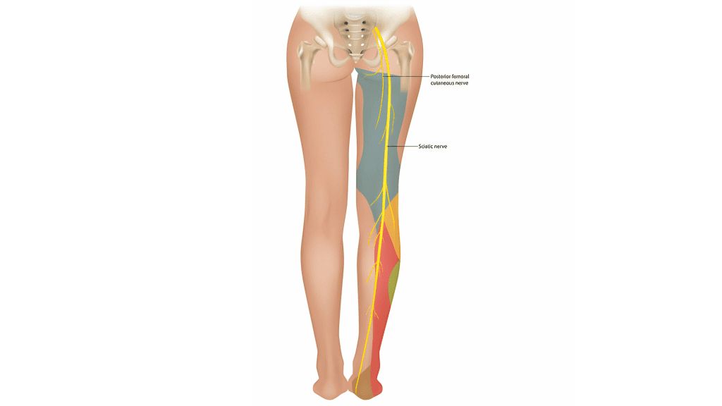 Sciatica treatment