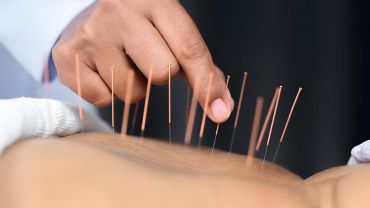 Dry Needling therapy