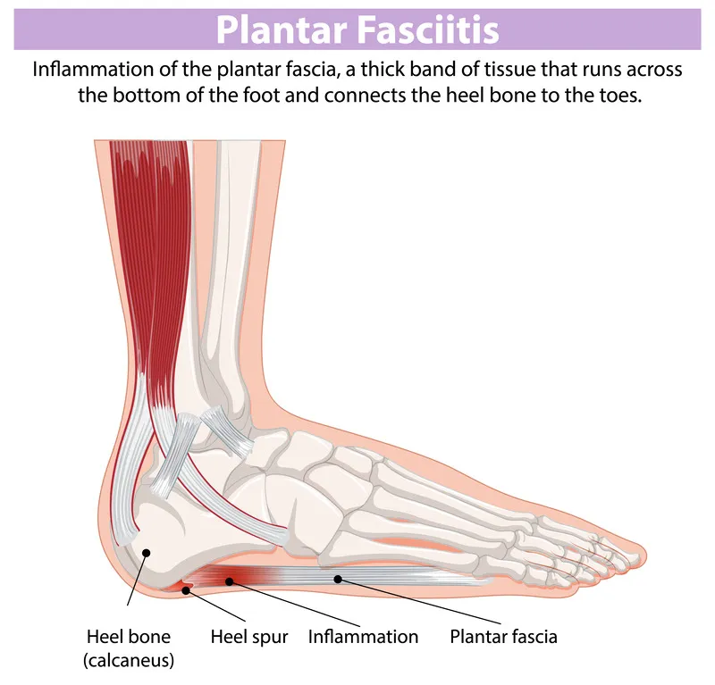 Plantar Fasciitis Treatment in Dubai