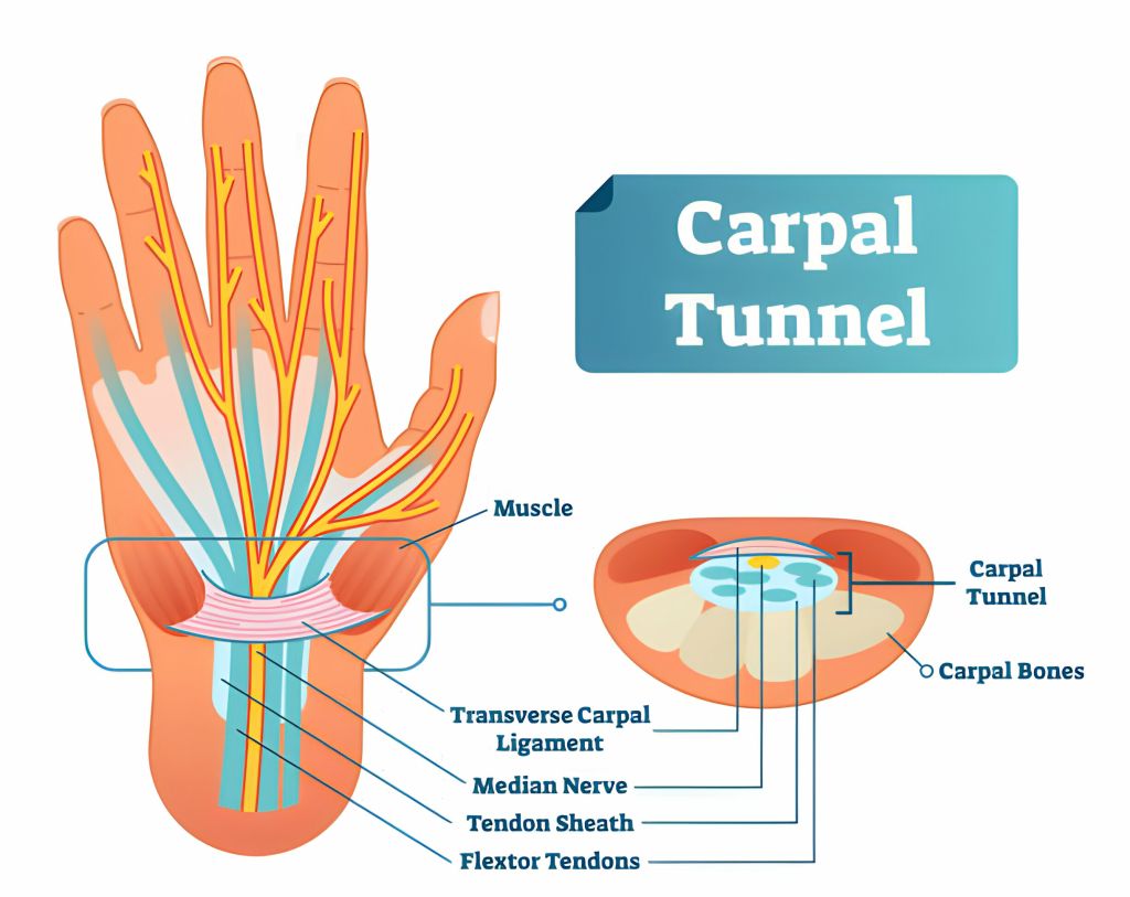 carpal tunnel syndrome