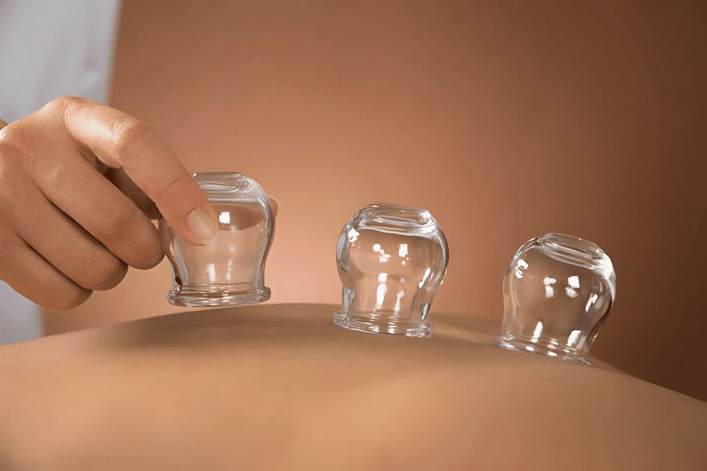 What is Cupping Therapy?