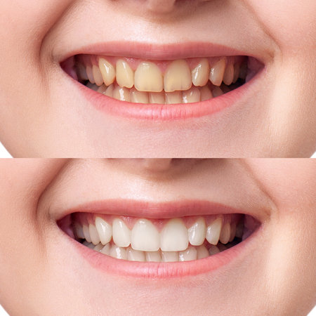 zoom teeth whitening results