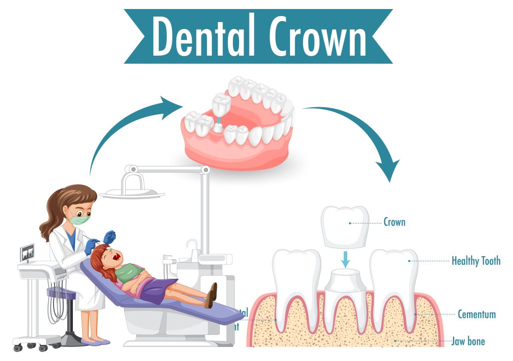 Dental Crown