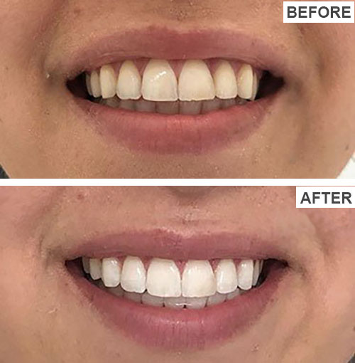 teeth whitening results