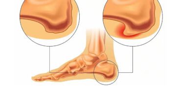 heel spur, or calcaneal spur