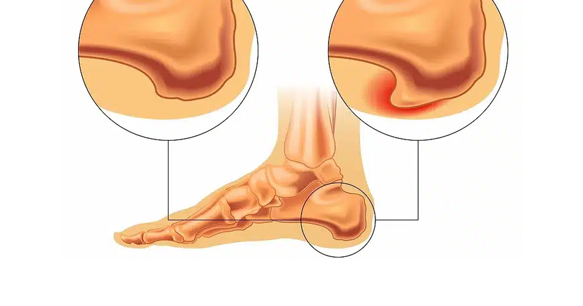 heel spur, or calcaneal spur