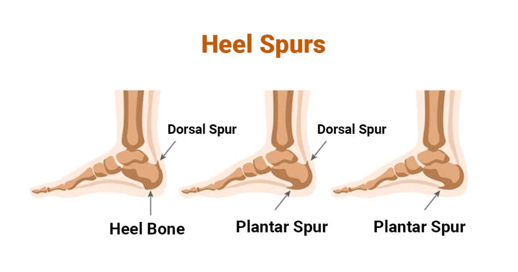 Types of Heel Spur