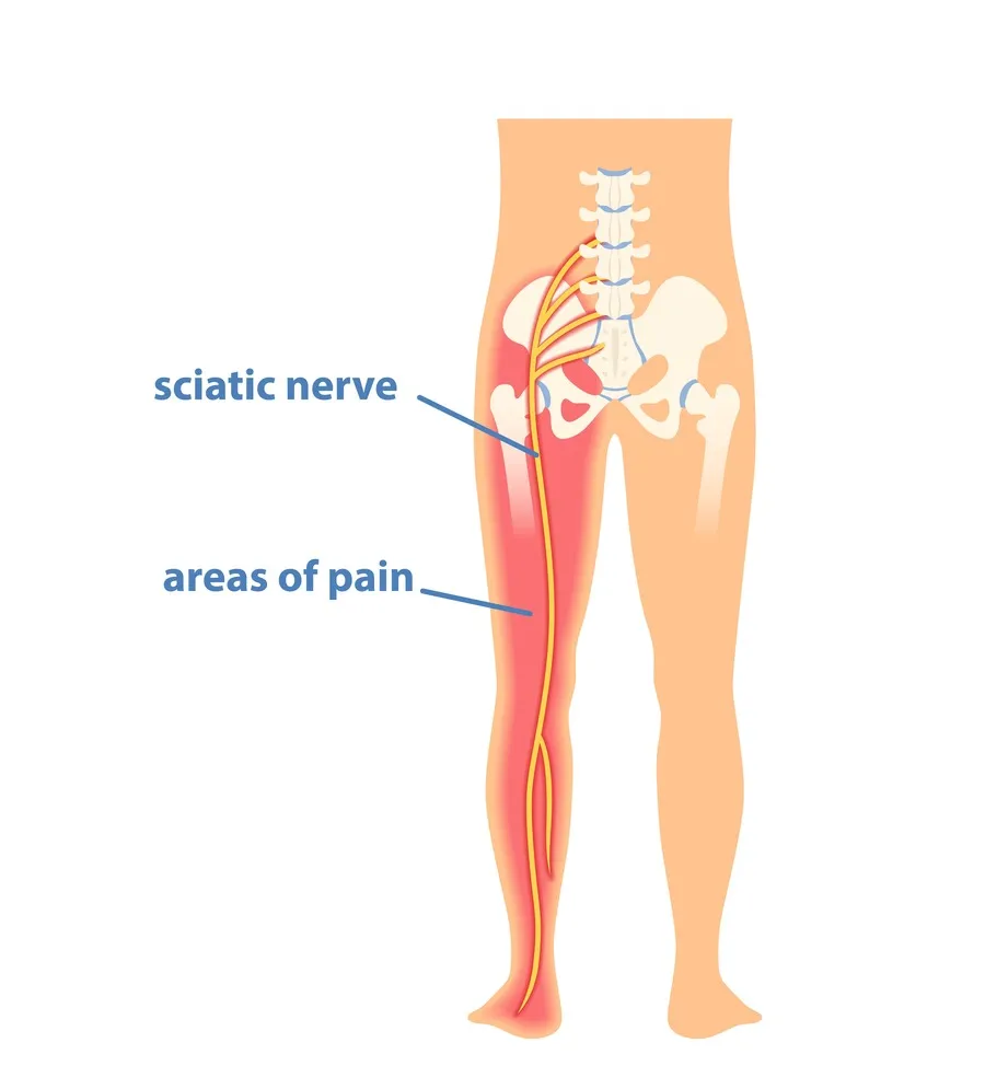 sciatica pain illustration