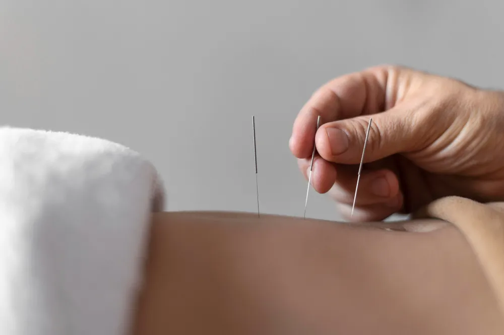 dry needling in dubai