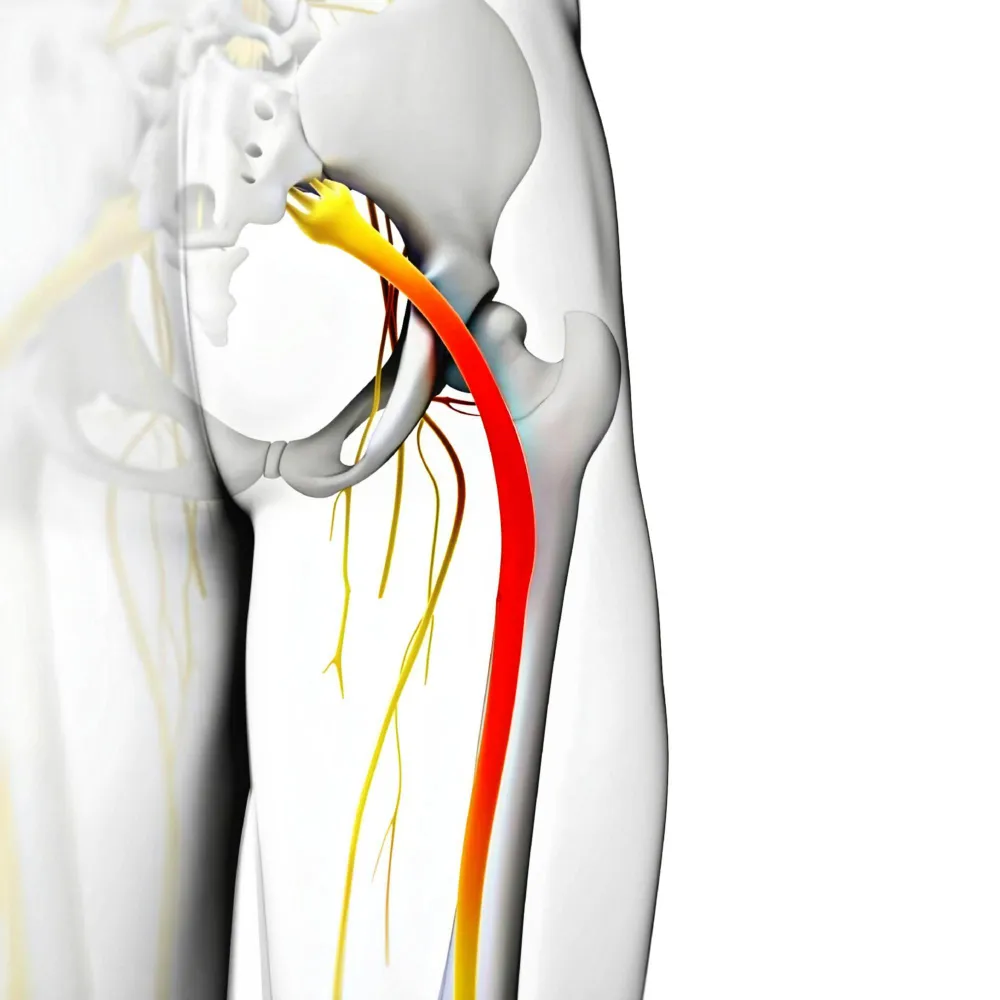 sciatica symptoms