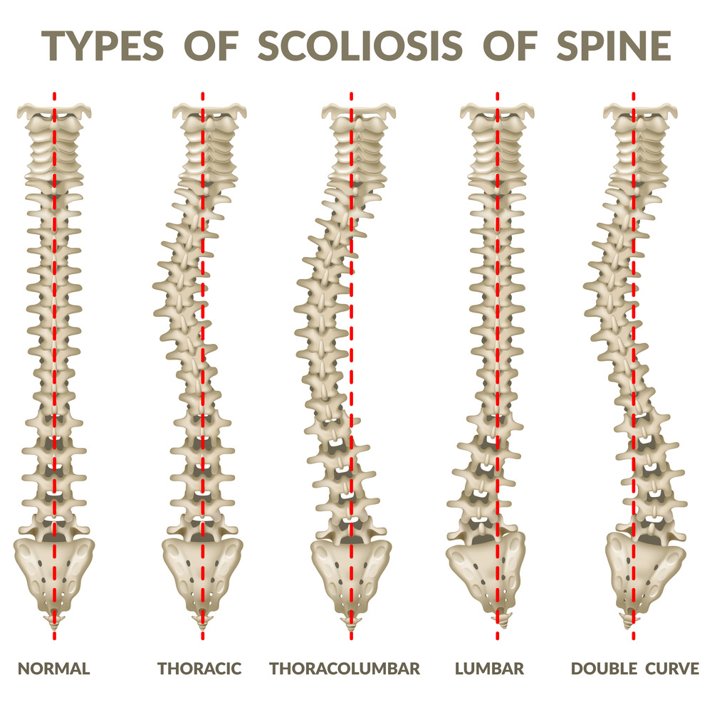 scoliosis illustration
