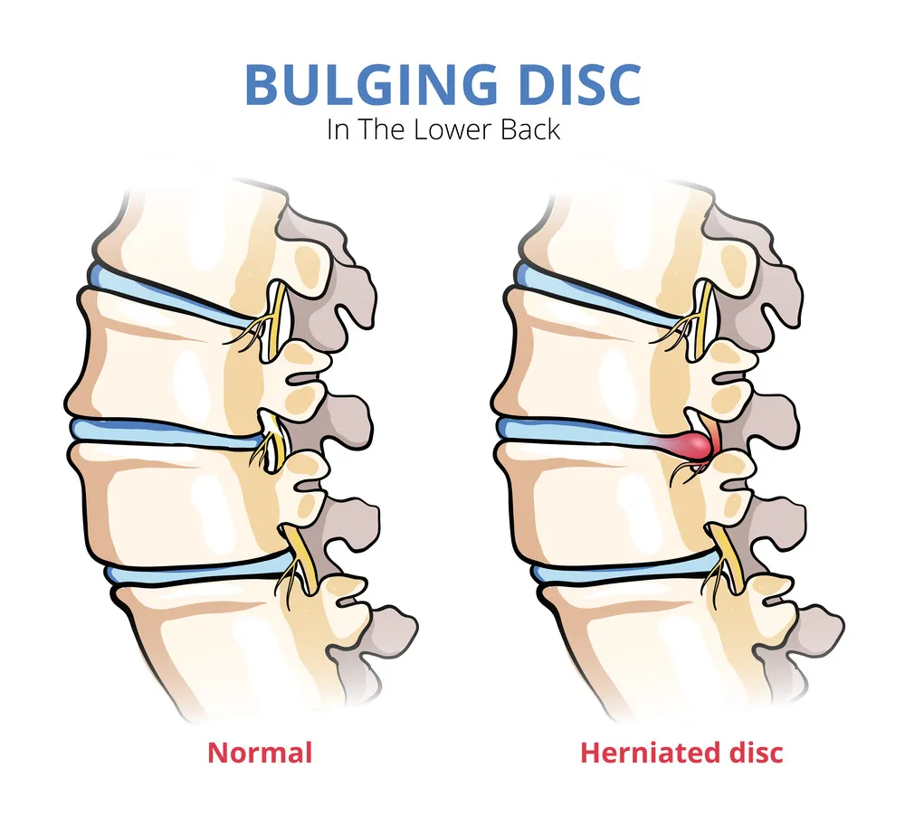 herniated disc diagram