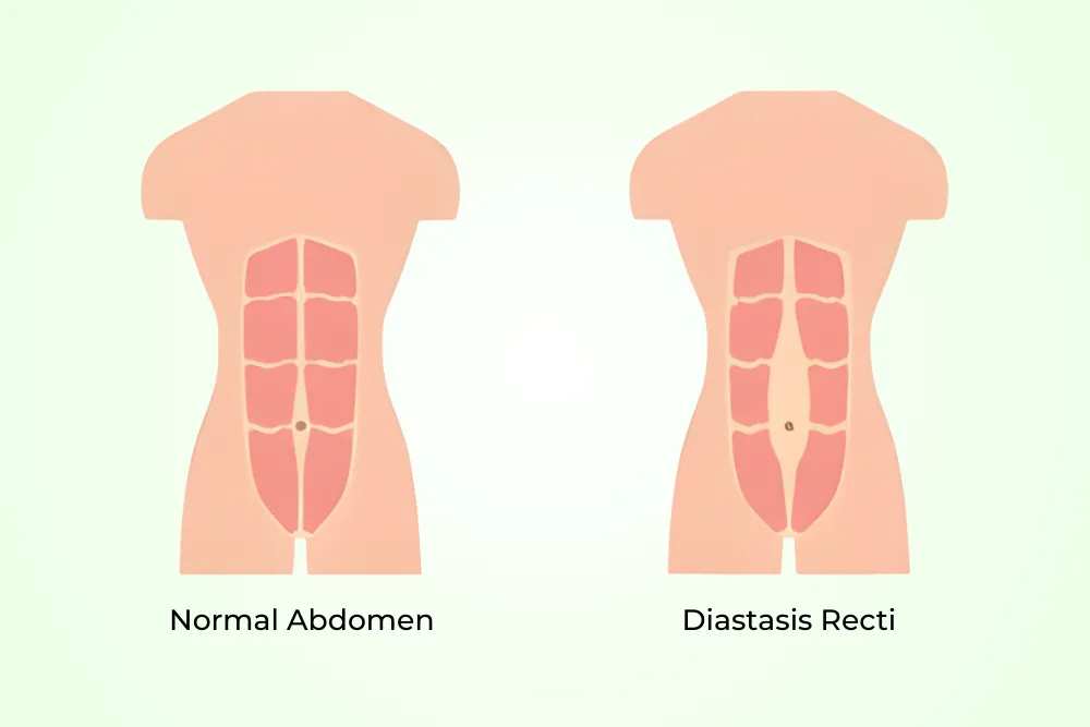 physiotherapy for diastasis recti