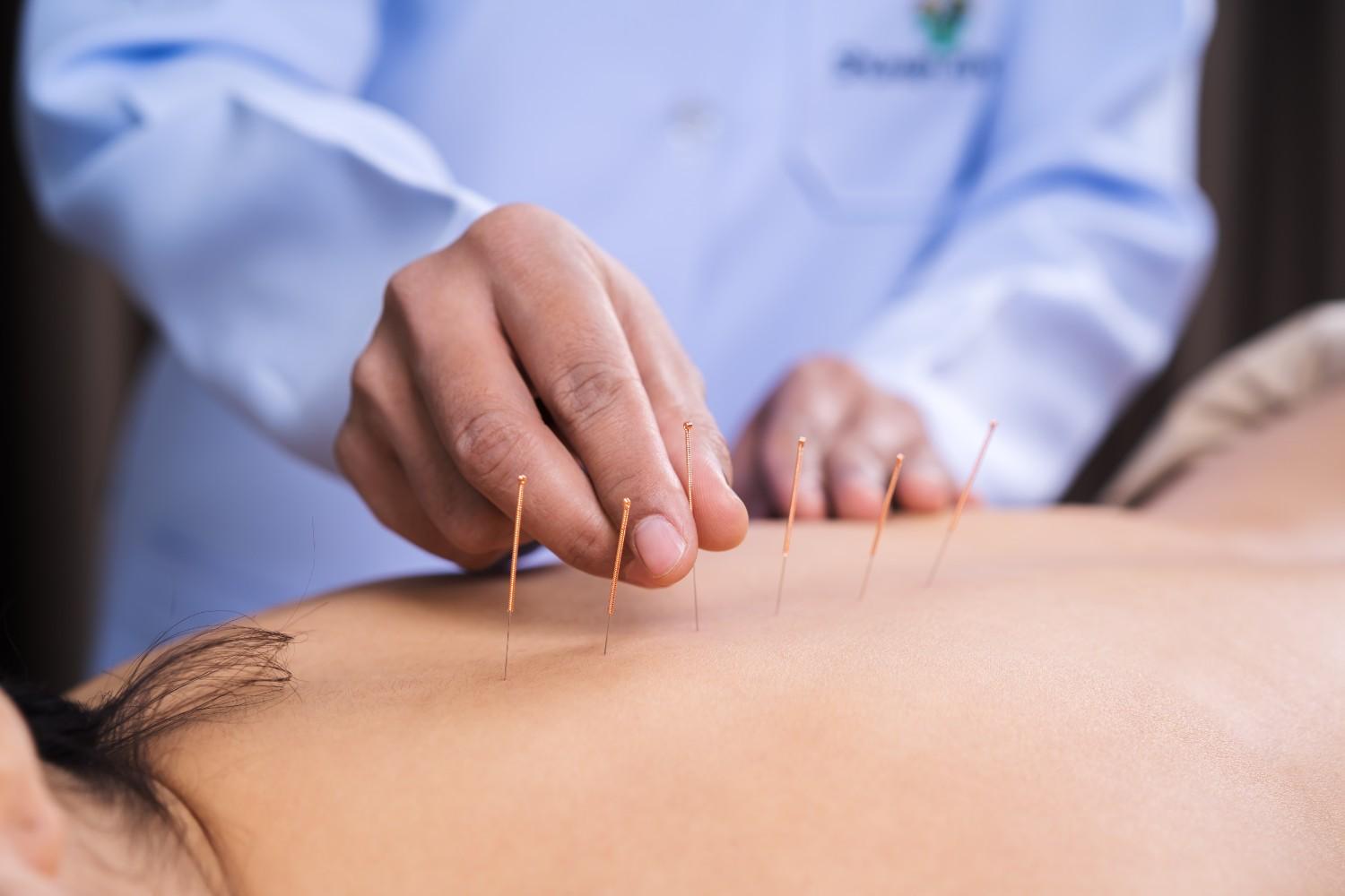 Advanced Physiotherapy to Treat Pain With Dry Needling Therapy