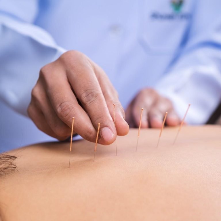 Advanced Physiotherapy to Treat Pain With Dry Needling Therapy