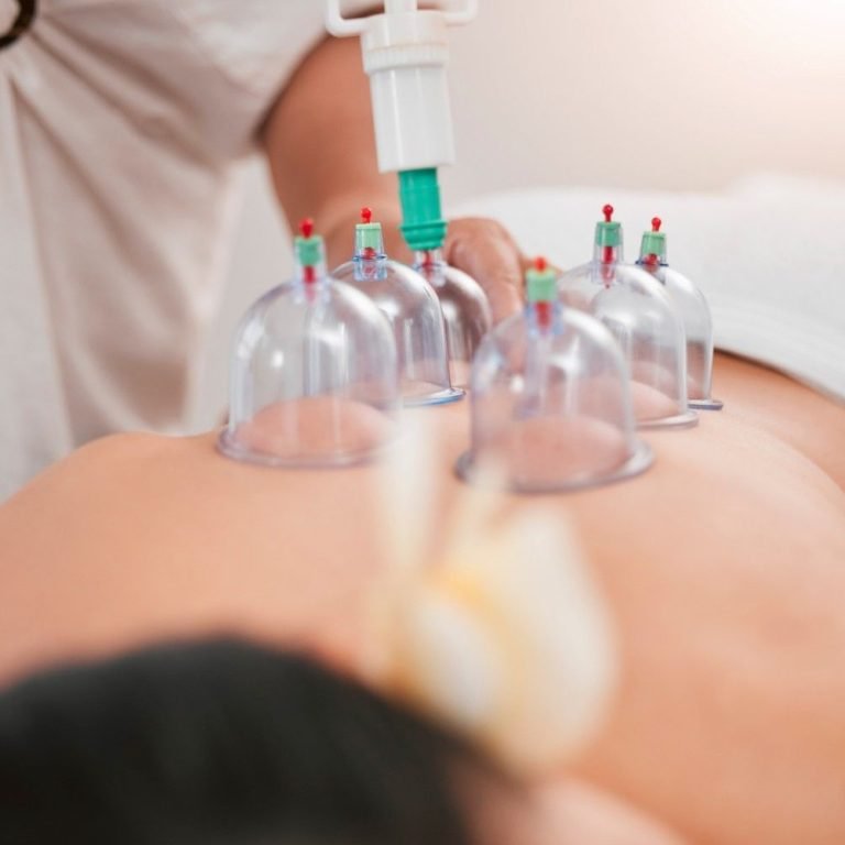 Cupping Therapy in Dubai