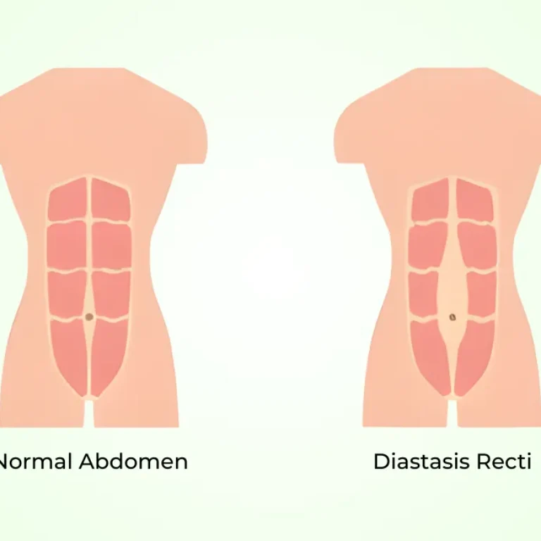 physiotherapy for diastasis recti