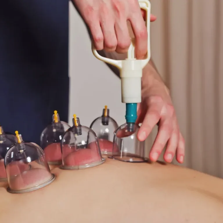 dry cupping